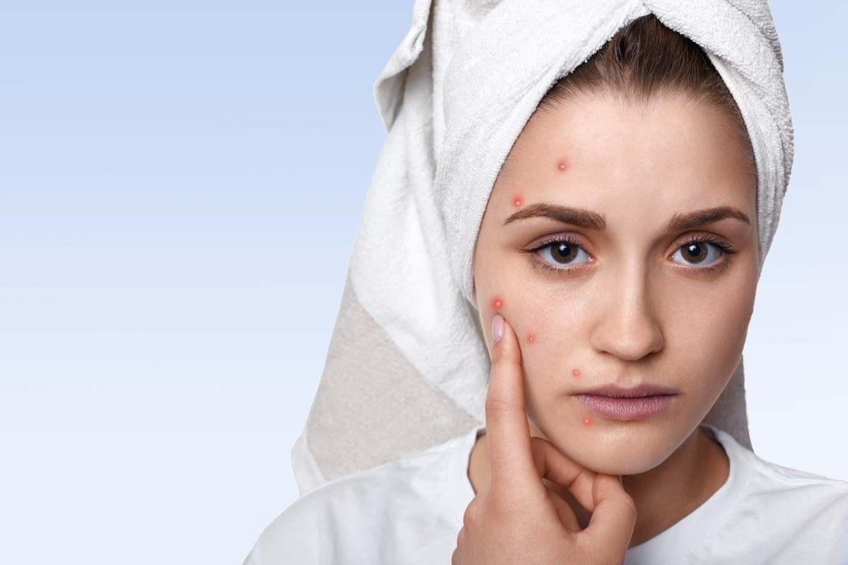 Acne & Pimple Treatment