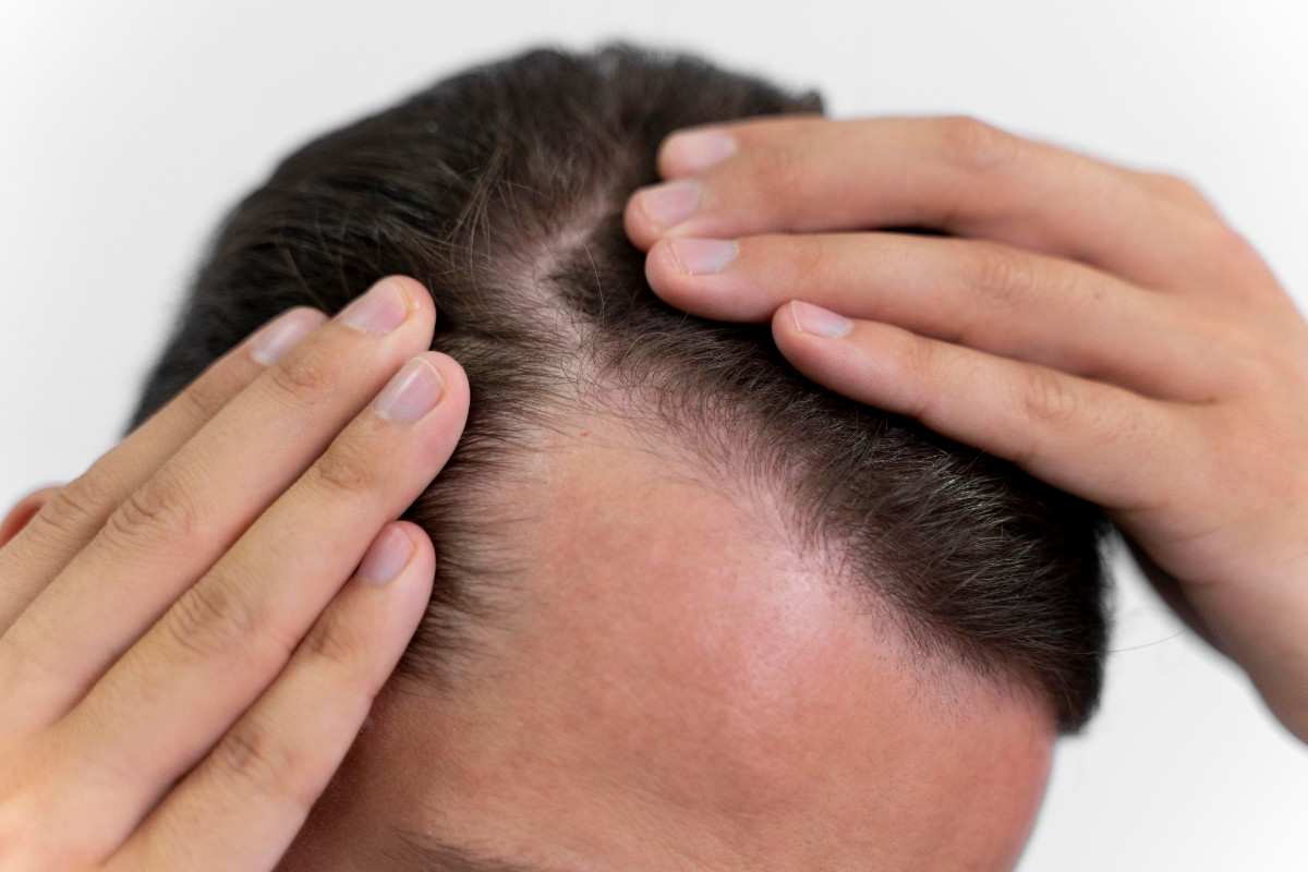 Hair Fall Treatment
