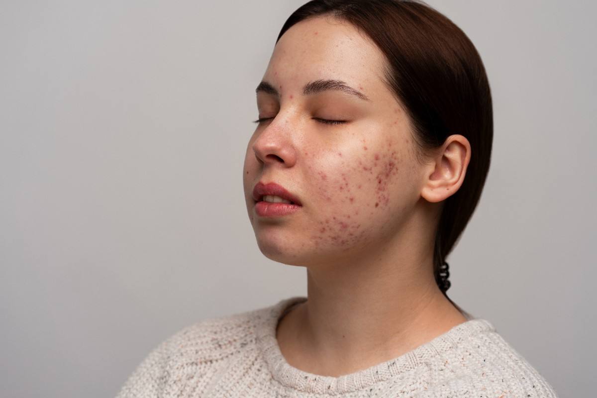 Acne Scar Treatment